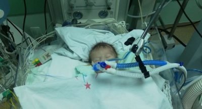 12 günlük bebeğe yapay damar takıldı